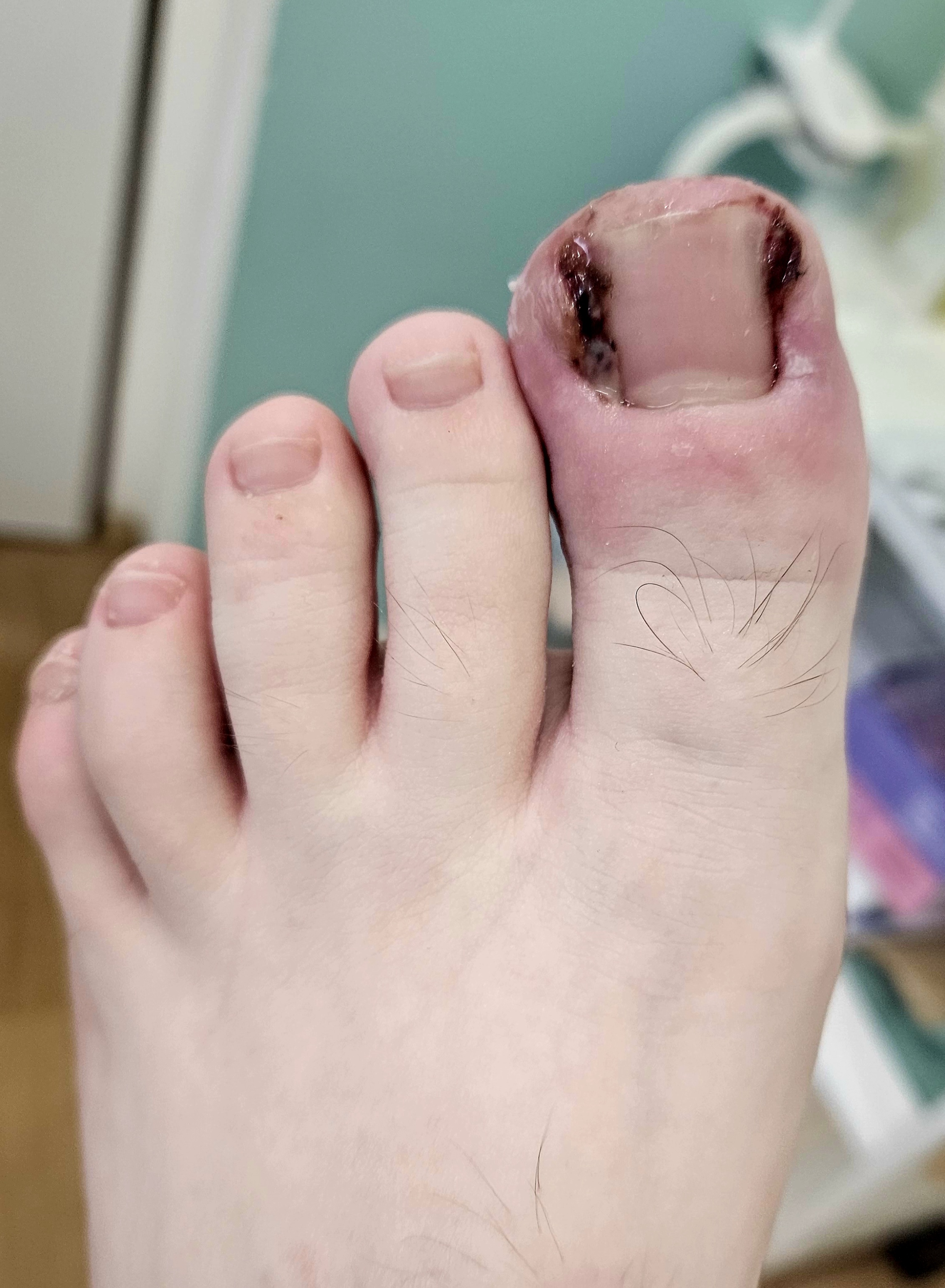 Detail palce na noze s podrážděním okolo nehtových valů a zaschlou krví po stranách nehtu.